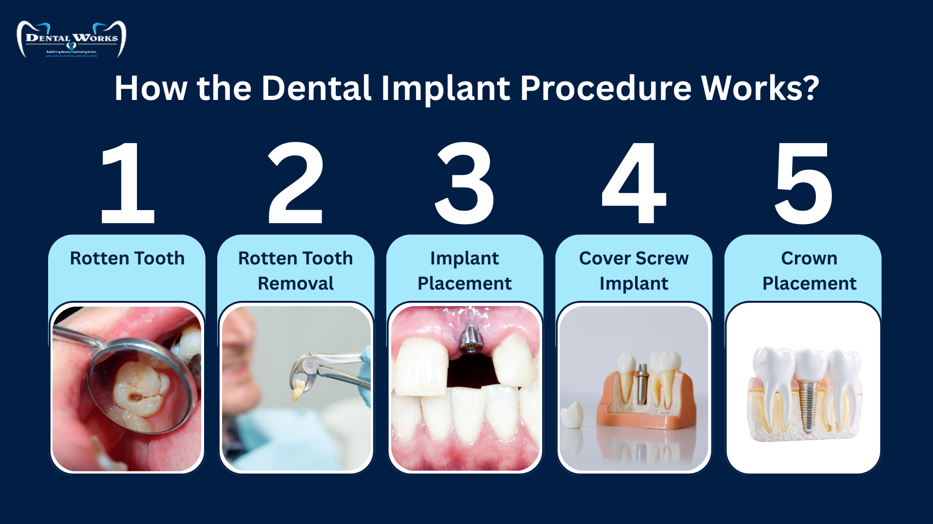 Dental Implant