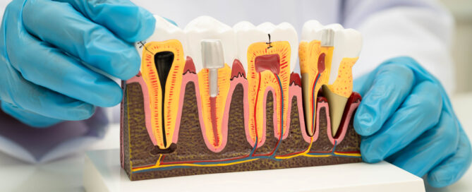Root Canal Treatment