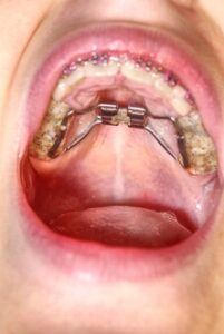 Orthodontic Appliances