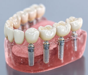 Basal Implants