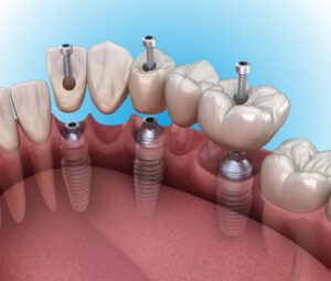 Dental Implant