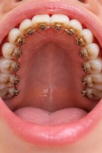 Lingual Braces