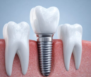 Single Tooth Implant
