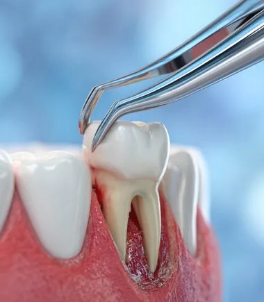 Tooth Extraction