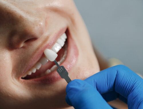 Porcelain Veneers and Teeth Veneers Cost: A Complete Patient Guide