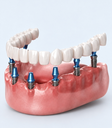 All on 6-8 Implant