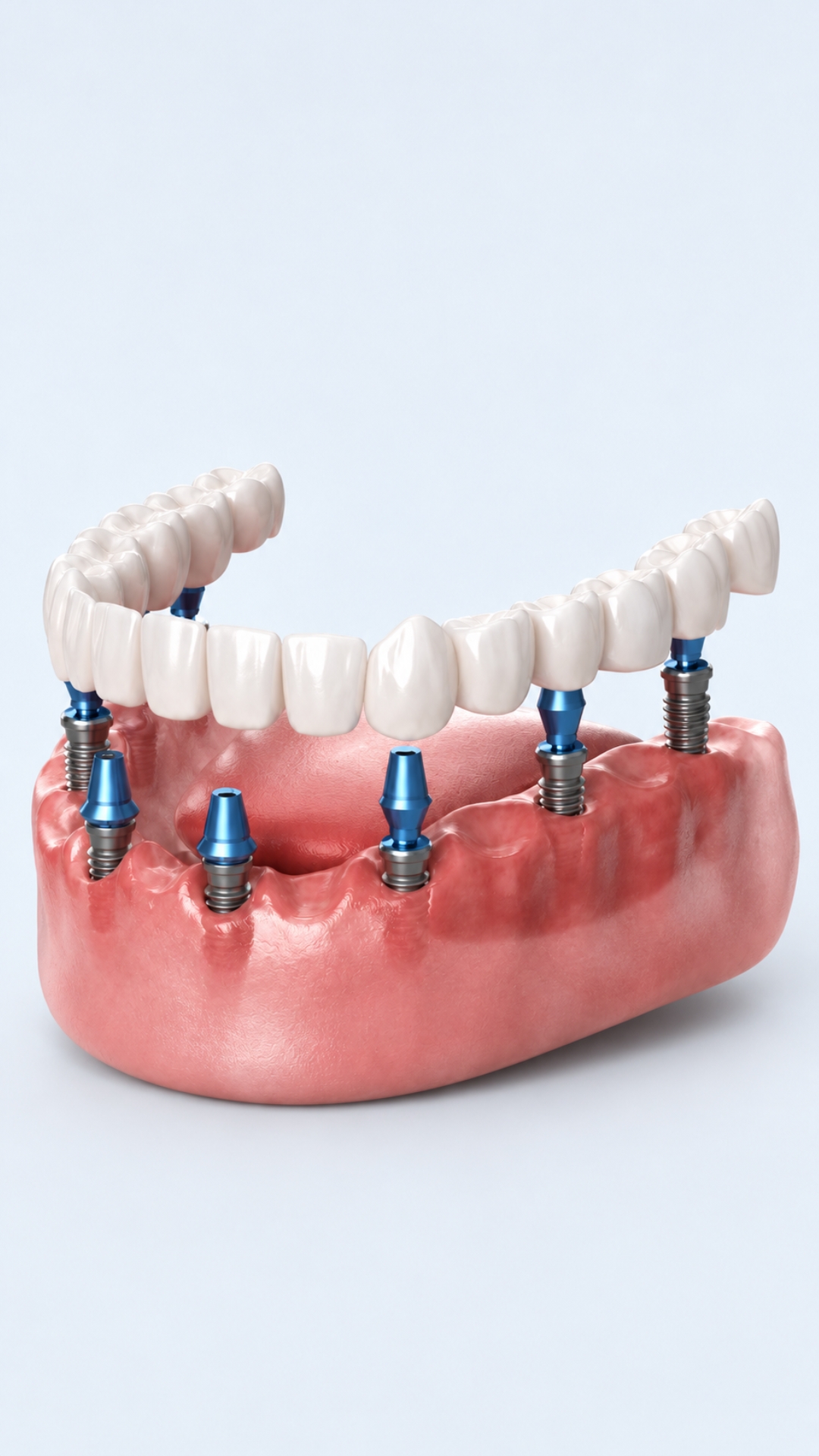 All on 6-8 Implant