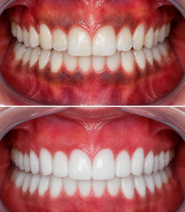 Gum-Depigmentation