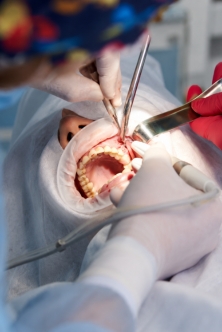 Microsurgeries Apicetomy