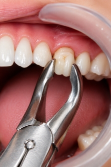Tooth Extraction