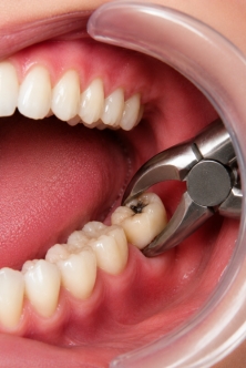 Wisdom Tooth Extractions