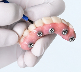 All on 4 Implants