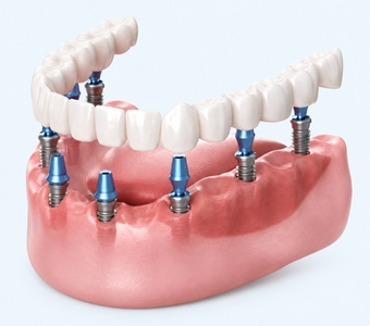 All on 6/8 Implants