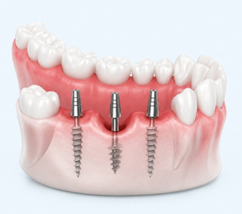 Basal Implants