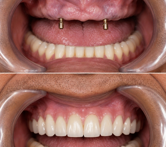 Dental Implant