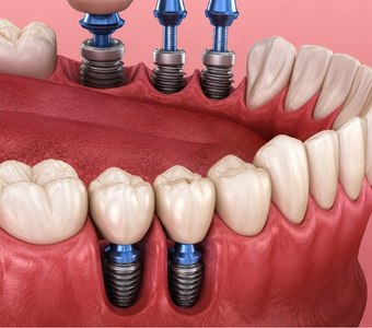 Multiple Implants