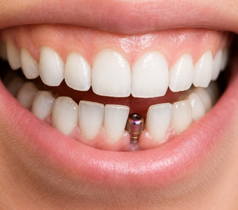Single Tooth Implant