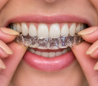Aligners