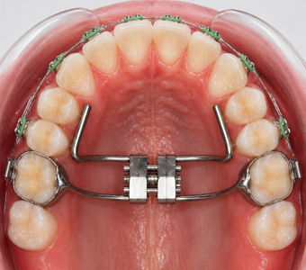 Orthodontic Appliances