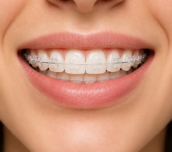 Ceramic Braces