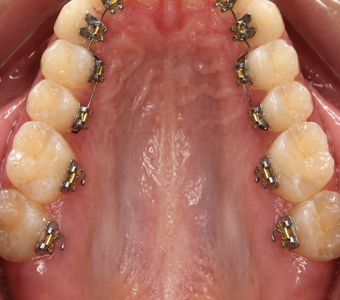 Lingual Braces