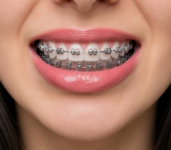Metal Braces